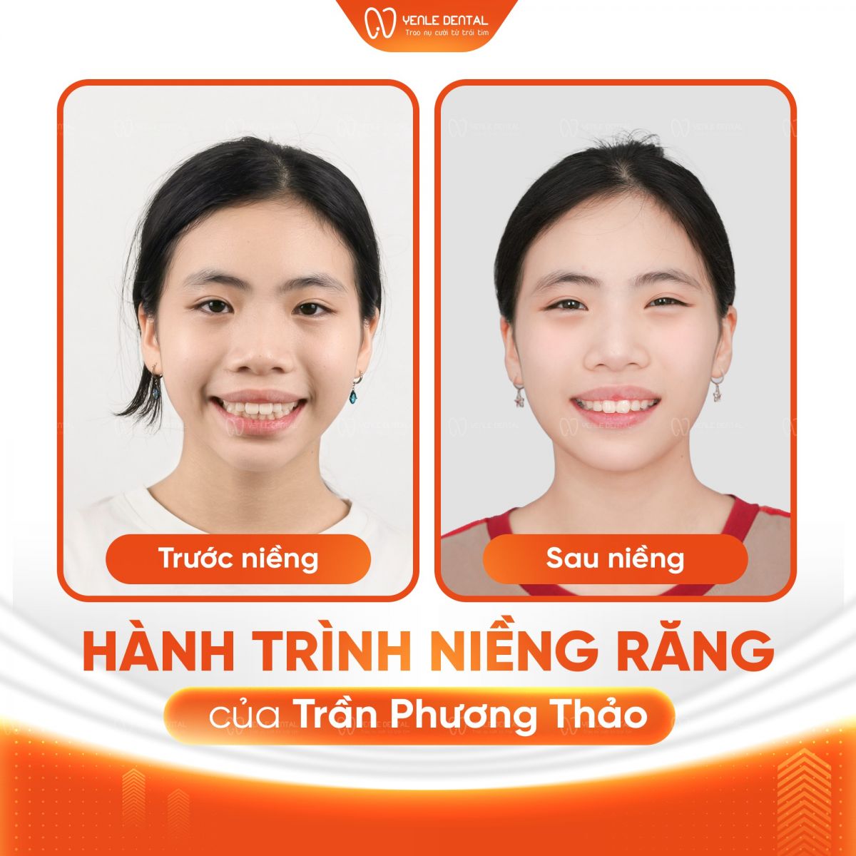 nieng-rang-cho-tre-em-co-nen-hay-khong