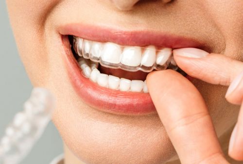 Quyết định niềng răng trong suốt bạn cần biết những điều này