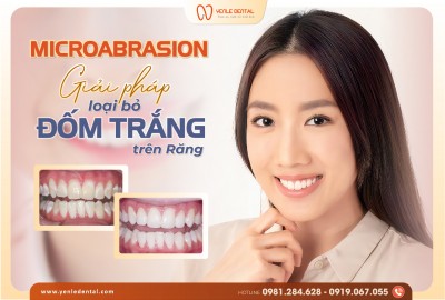 Microabrasion: Giải pháp cho nụ cười hoàn hảo không tì vết