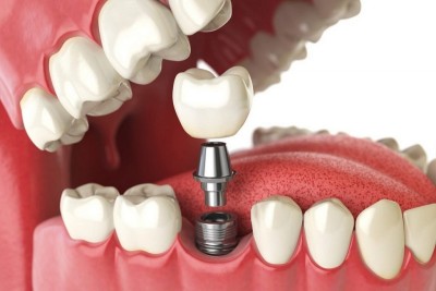 Cấy răng Implant gồm những bước nào? Tìm hiểu quy trình chuẩn tại nha khoa