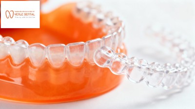 Niềng răng trong suốt bán phần – Lựa chọn tiết kiệm