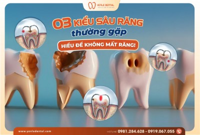 Các Loại Sâu Răng Thường Gặp và Cách Ngăn Ngừa Hiệu Quả