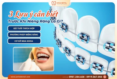3 LƯU Ý CẦN BIẾT TRƯỚC KHI NIỀNG RĂNG