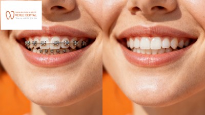 Niềng răng thẩm mỹ trong suốt tại Hải Phòng