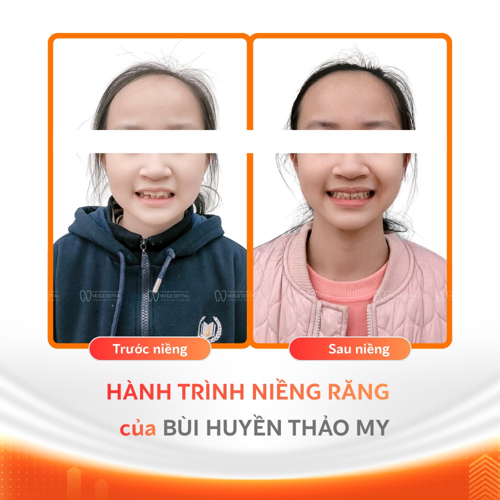 Niềng răng độ tuổi vàng 8-12 tuổi