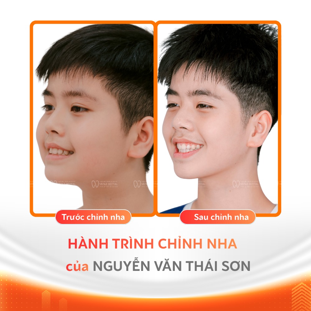 15 tuổi niềng răng bao nhiêu tiền - Yenle Dental