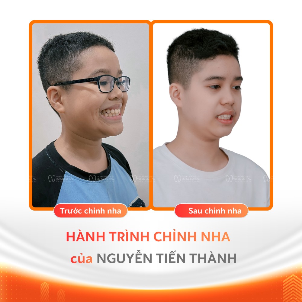 15 tuổi niềng răng bao nhiêu tiền