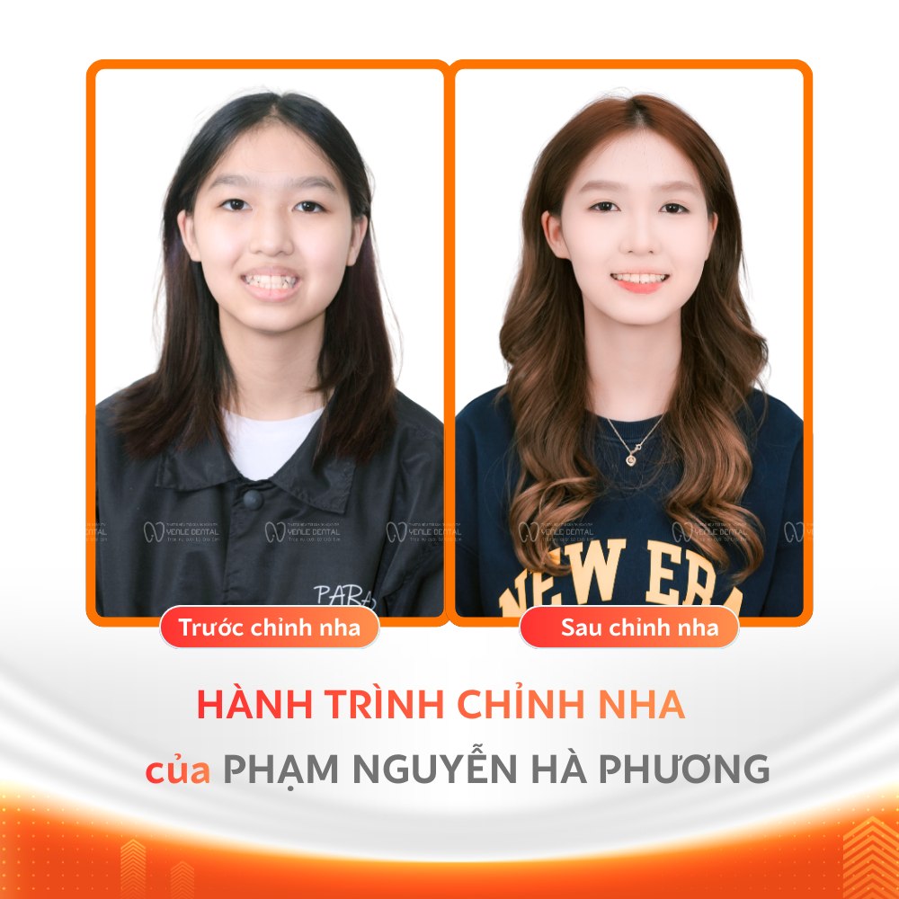 15 tuổi niềng răng bao nhiêu tiền