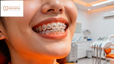 Niềng răng toàn diện – Lựa chọn hoàn hảo cho nụ cười cân đối