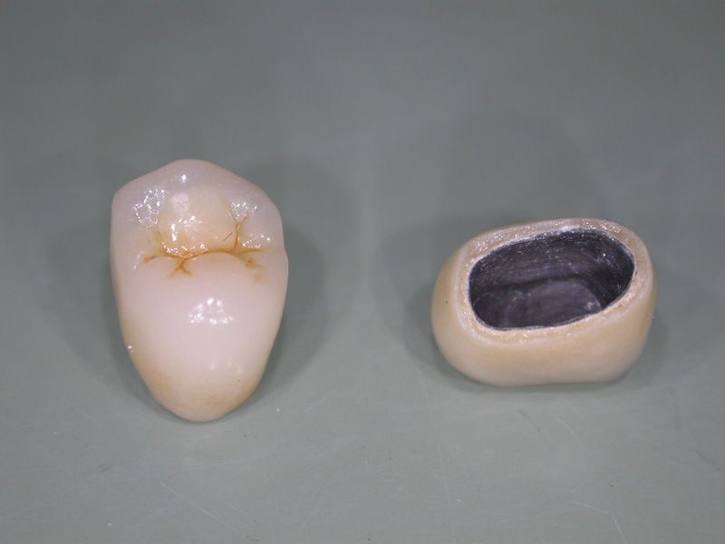 Tại sao không nên làm răng sứ giá rẻ?