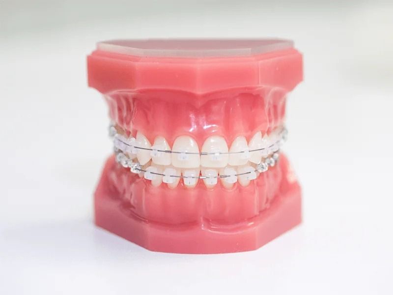 Niềng răng mắc cài sứ