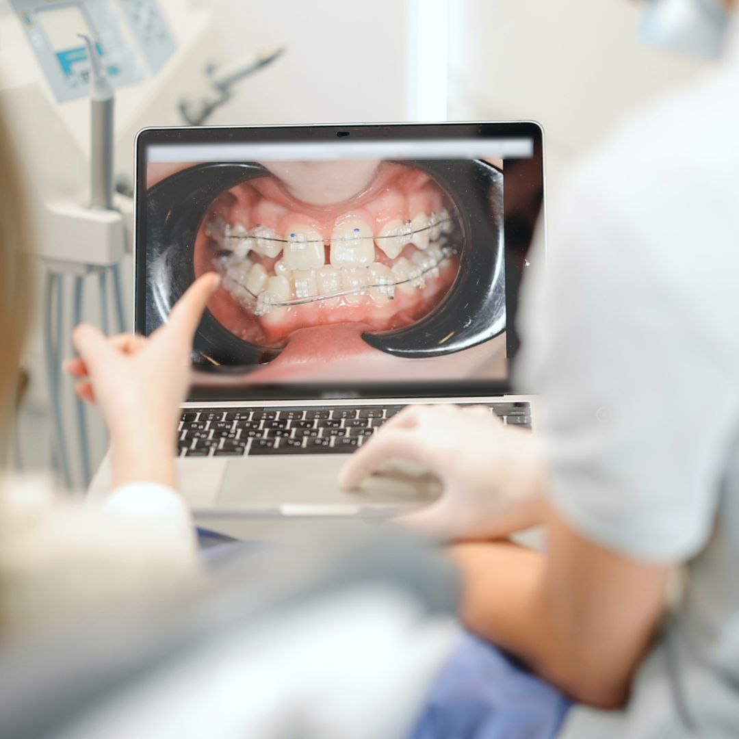 Chi Phí Niềng Răng Cập Nhật Mới Nhất 2026