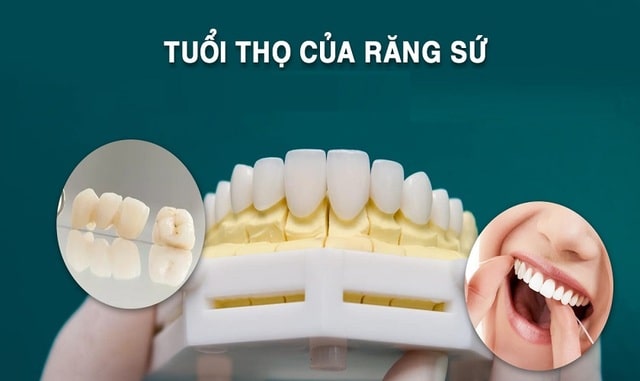 Bí quyết giúp tăng tuổi thọ cho răng bọc sứ bạn nên biết