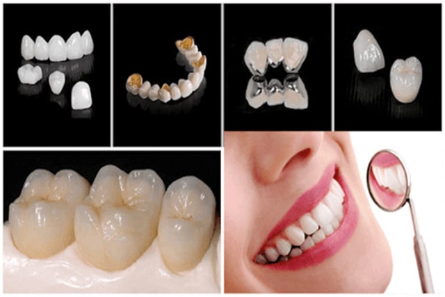 Bọc mão sứ titan bao nhiêu tiền phụ thuộc nhiều yếu tố