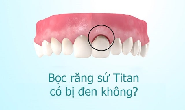 Bọc mão sứ titan vẫn khó tránh khỏi việc viền nướu bị đen