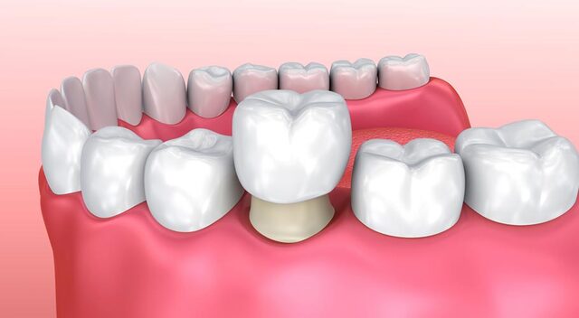 Bọc răng sứ là gì? 5 điều bạn nhất định phải biết nếu định bọc răng sứ 