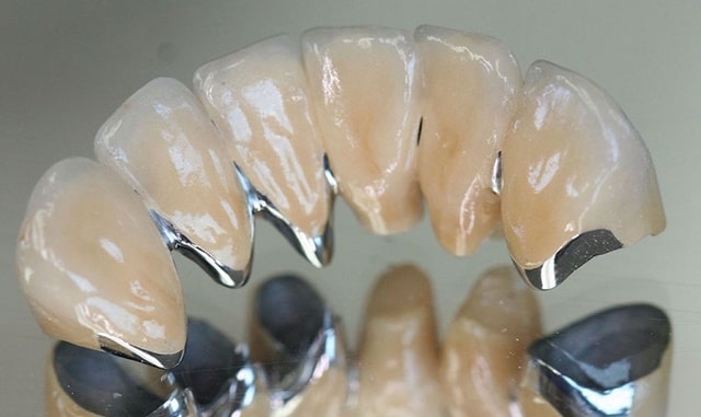 Bọc răng sứ lõi titan có nhiều ưu điểm