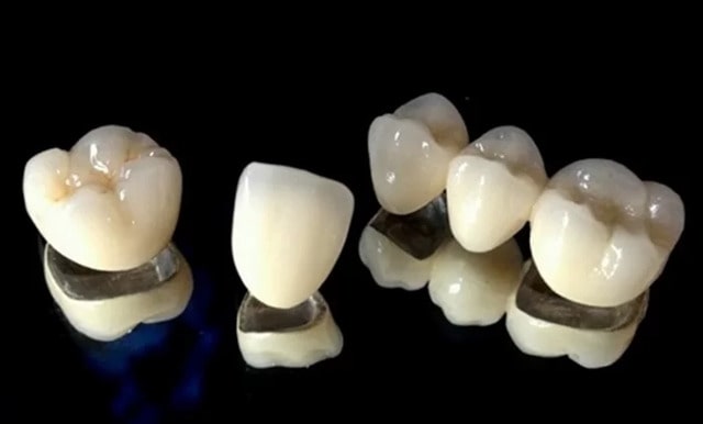 Bọc răng sứ titan bao nhiêu tiền? 6 điều bạn cần biết về răng sứ titan