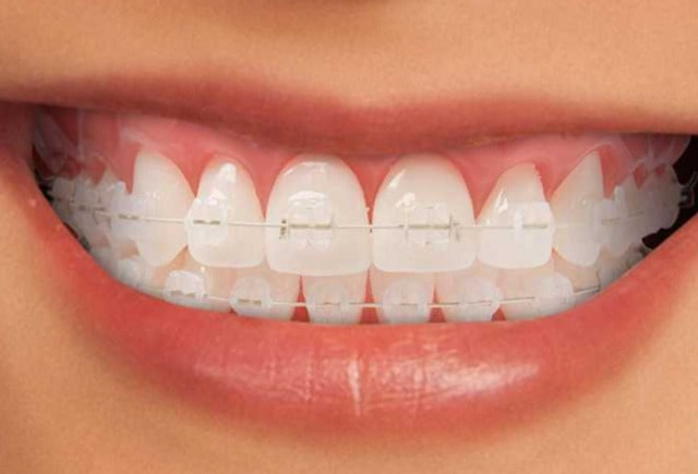 Chi phí nắn chỉnh răng phụ thuộc vào nhiều yếu tố