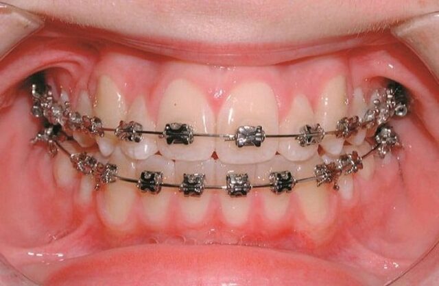 Chỉnh nha bao nhiêu tiền? Từ A - Z những điều cần biết về chỉnh răng