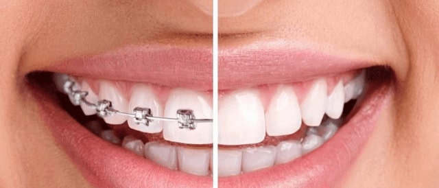 Chỉnh nha là phương pháp giúp chẩn đoán và điều chỉnh những tình trạng khớp cắn, cơ, răng bị sai lệch