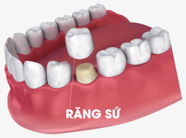 Có nhiều dịch vụ làm răng sứ