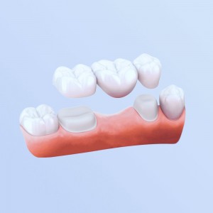 Cầu Răng Sứ Là Gì? Làm Cầu Răng Sứ Có Tốt Không?