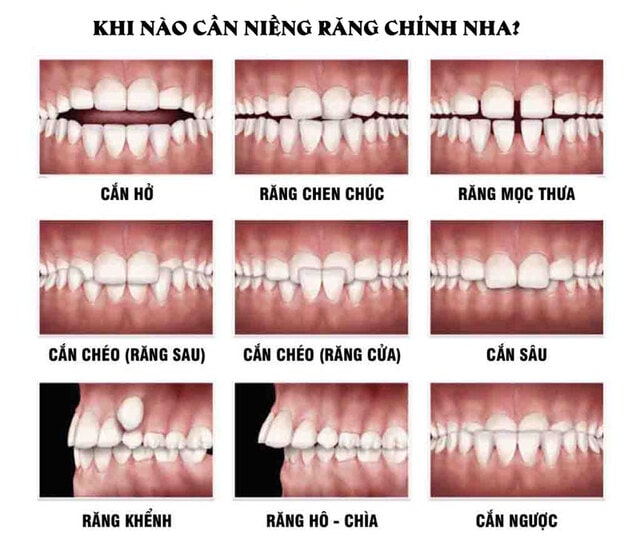 Đây là những trường hợp cần thực hiện điều chỉnh răng Sau khi điều chỉnh tất cả những vấn đề về răng và khớp hàm kể trên, b