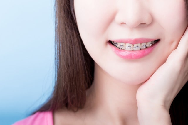 Điều chỉnh răng với mắc cài titan