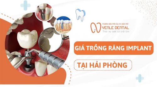 Giá trồng răng Implant tại Hải Phòng bao nhiêu? Cập nhật mới nhất