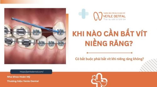 Khi nào cần bắt vít niềng răng? Có bắt buộc không?