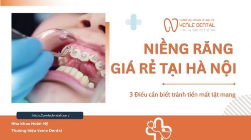 Niềng răng giá rẻ tại Hà Nội: 3 Điều cần biết để tránh 