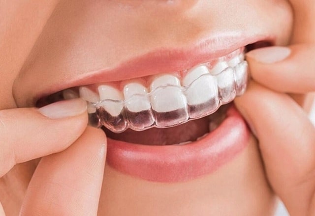 Nắn chỉnh răng với invisalign