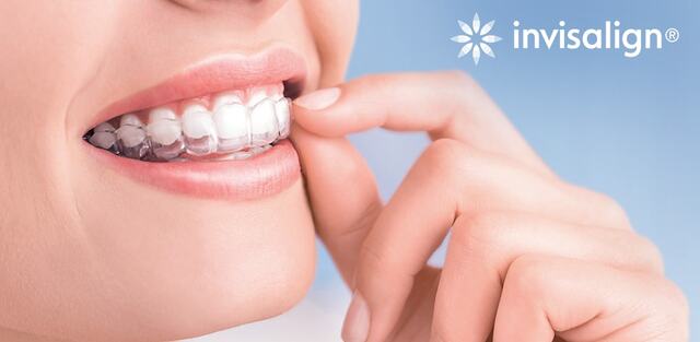 Niềng răng Invisalign có các mấu chỉnh nha được gắn trực tiếp trên bề mặt răng, hiệu quả, an toàn, thẩm mỹ nhưng khá tốn kém