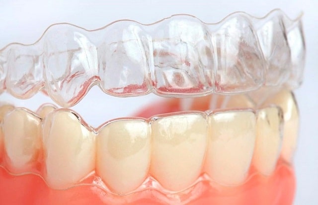 Niềng răng trong suốt còn được gọi là niềng răng không mắc cài