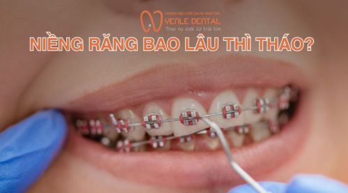Niềng răng bao lâu thì tháo? Dấu hiệu sắp tháo niềng