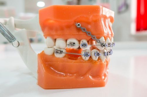 Cắm Minivis Niềng Răng Có Đau Không? Bí Quyết Nhanh Lành