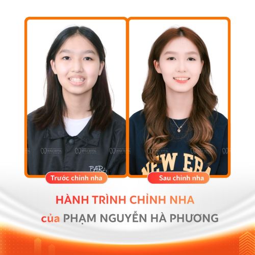 Niềng Răng Trả Góp 0% Tại Hải Phòng: Giải Pháp Tài Chính Sinh Viên
