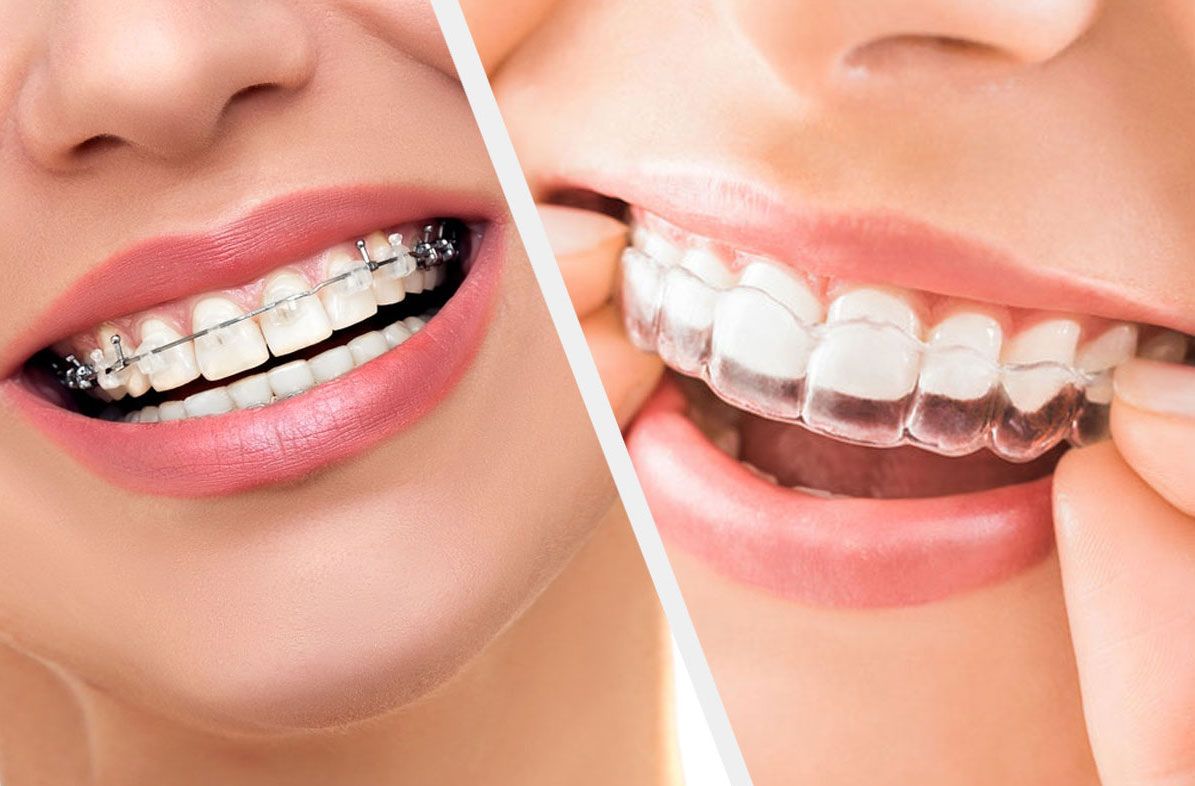 niềng răng làm thay đổi cấu trúc khuôn mặt