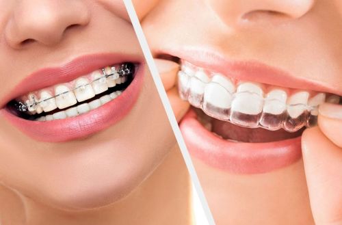 Niềng Răng Invisalign Có Ưu Điểm Gì So Với Mắc Cài Truyền Thống?