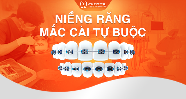Niềng răng mắc cài tự buộc
