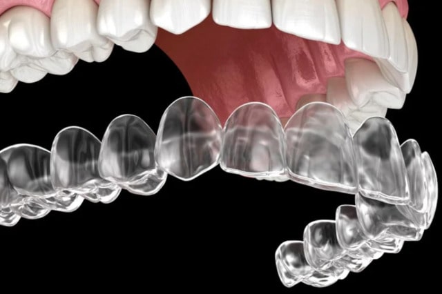 Quy trình niềng răng không mắc cài thông thường có 4 bước