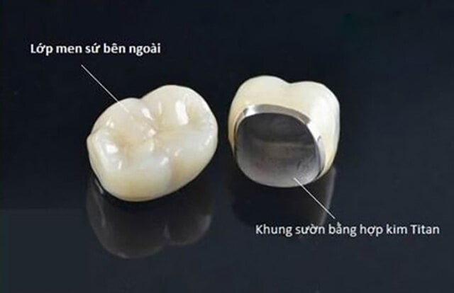 Răng sứ lõi titan có cấu tạo 2 phần rõ rệt