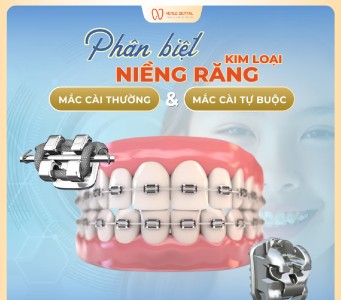 Niềng Răng Mắc Cài Kim Loại: Thường hay Tự Buộc – Lựa Chọn Nào Dành Cho Bạn?