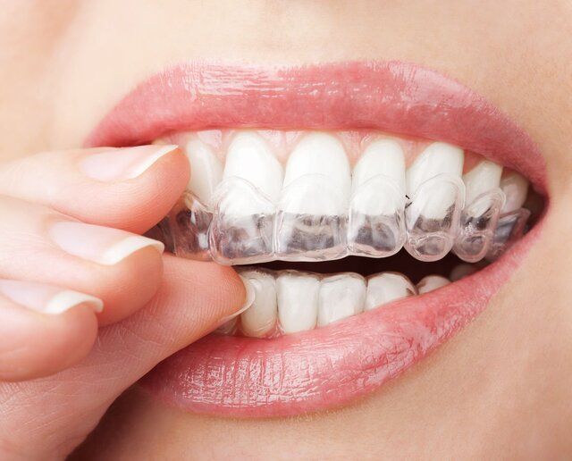 Thời gian niềng răng phụ thuộc chủ yếu vào tình trạng răng của mỗi người