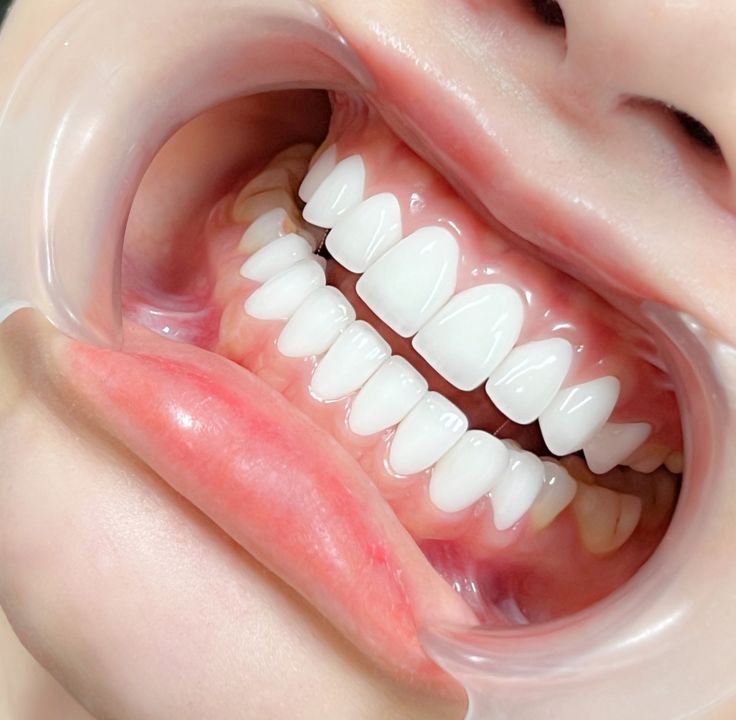 Tại sao không nên làm răng sứ giá rẻ?