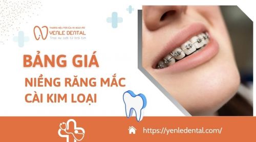 Bảng giá niềng răng mắc cài kim loại cập nhật mới nhất 2026