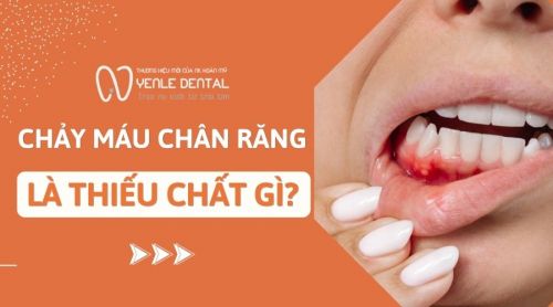 Bị chảy máu chân răng là thiếu chất gì, phải làm sao?