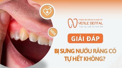Bị sưng nướu răng có tự hết không? Khi nào cần điều trị?