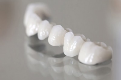 Bọc răng sứ titan bao nhiêu tiền? 6 điều bạn cần biết về răng sứ titan